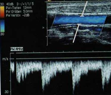 Messung der Flussgeschwindigkeit in einer Arterie